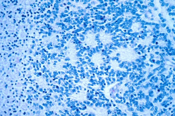 Scoperto alla Federico II il gene che scatena il neuroblastoma infantile Ingrandimento al microscopio di cellule tumorali