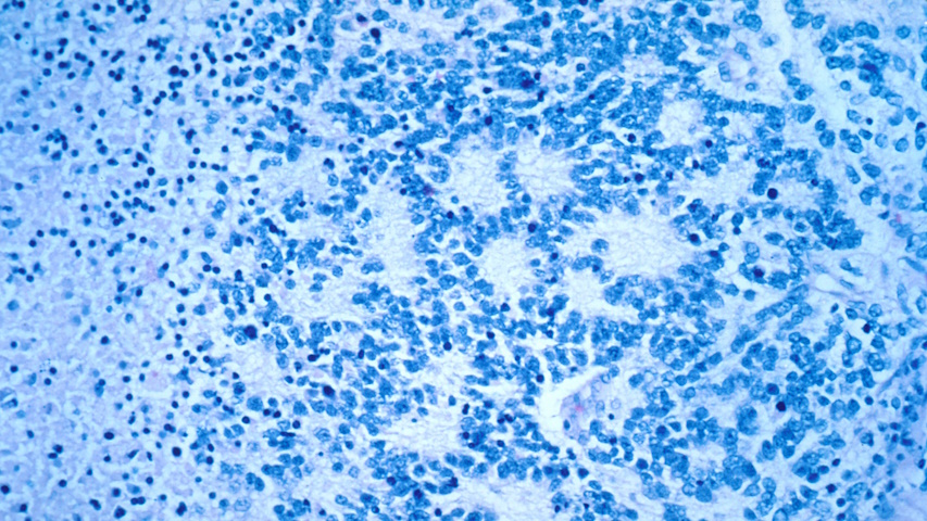 Ingrandimento al microscopio di cellule tumorali